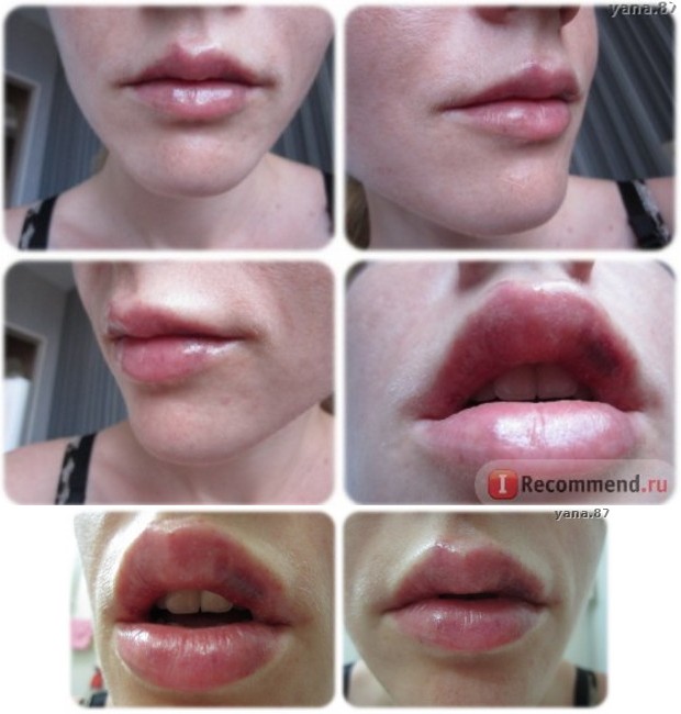 Второй день губ после гиалуроновой кислоты - фото