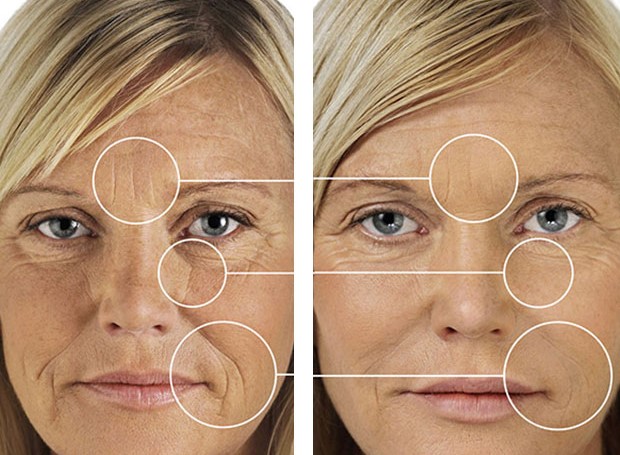 Действие гиалуроновой кислоты на кожу лица