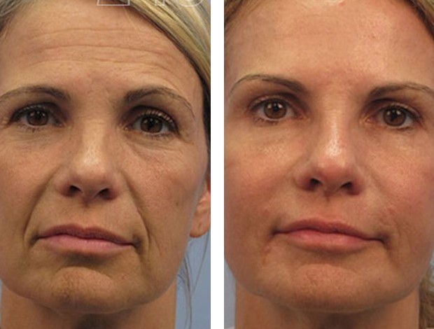 Влияние гиалуроновой кислоты на кожу лица