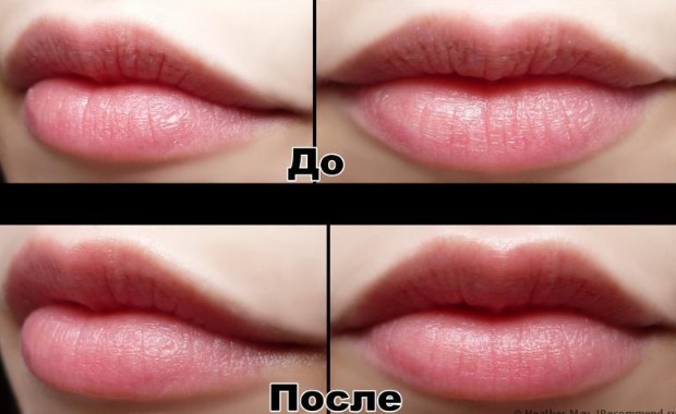 Фото до и после увлажнения губ гиалуроновой кислотой