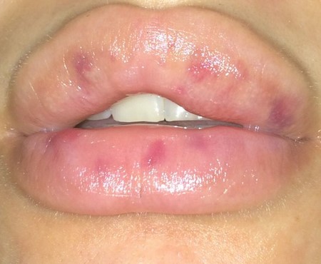 Комки в губах после гиалуроновой кислоты