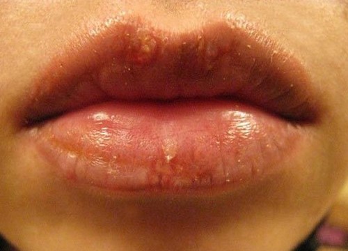 Герпес после введения гиалуроновой кислоты в губы