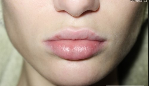 Как долго держится гиалуроновая кислота в губах 